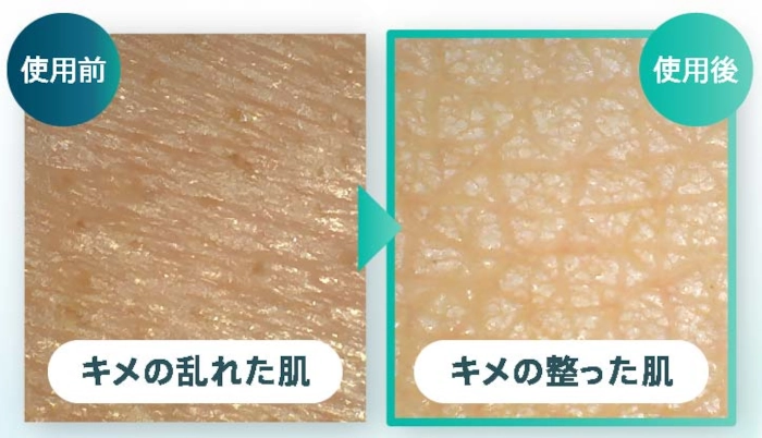 オンマイスキンで肌のきめが整ったビフォーアフター
