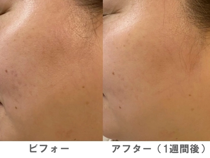 カレントボディLEDマスク ビフォーアフター（使用前使用後の比較写真）