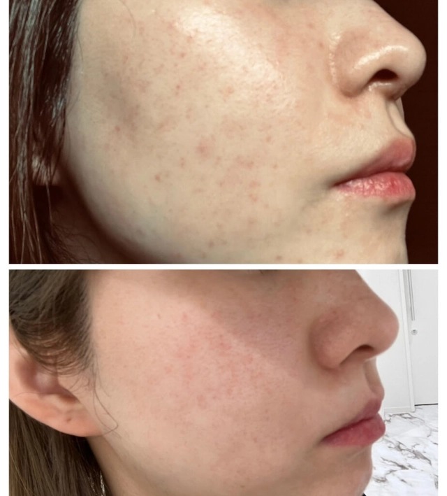 hanarabo赤ら顔(酒さ)ビフォーアフター