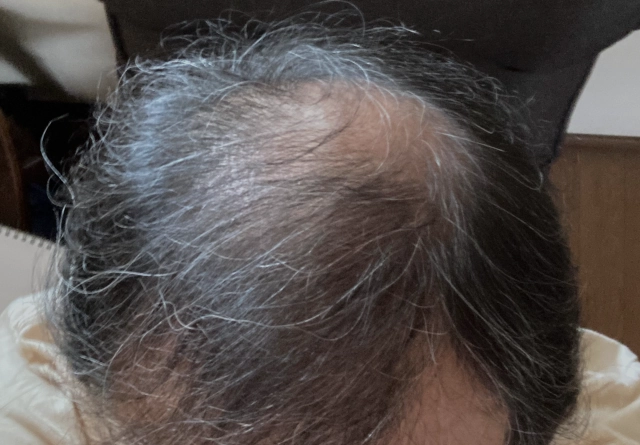 薄毛20251019の状態